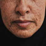 Acne Scars And How To Reduce Them