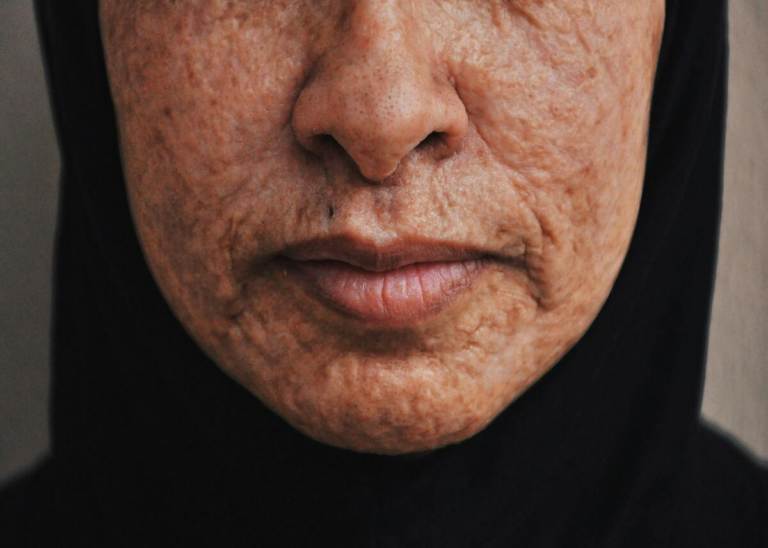 Acne Scars And How To Reduce Them