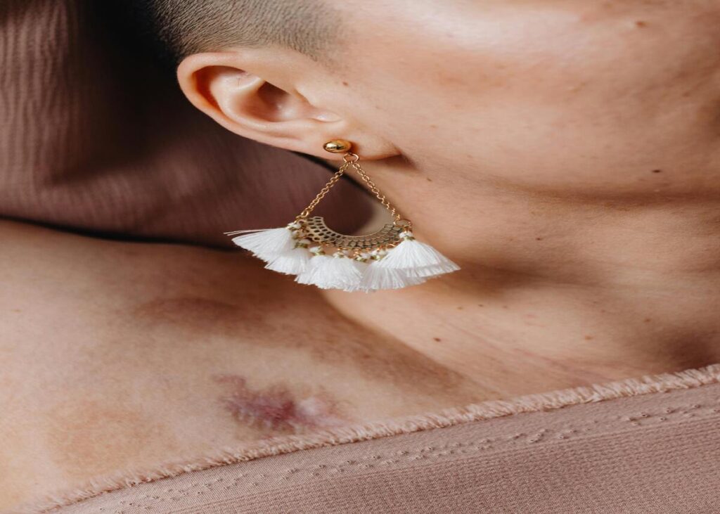 How to reduce acne scars