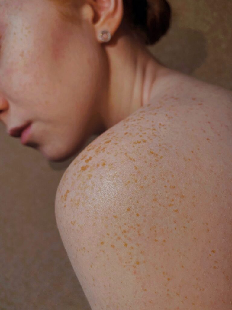Understanding Hyperpigmentation and How to Treat It For Good